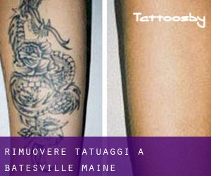 Rimuovere Tatuaggi a Batesville (Maine)