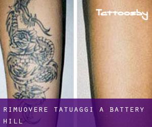 Rimuovere Tatuaggi a Battery Hill