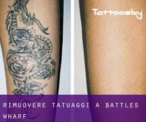 Rimuovere Tatuaggi a Battles Wharf