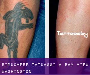 Rimuovere Tatuaggi a Bay View (Washington)