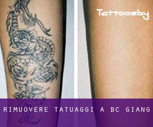 Rimuovere Tatuaggi a Bắc Giang