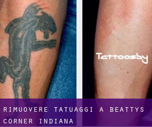 Rimuovere Tatuaggi a Beattys Corner (Indiana)