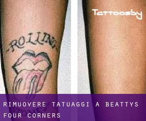 Rimuovere Tatuaggi a Beattys Four Corners