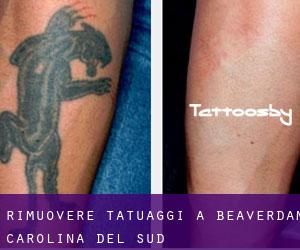 Rimuovere Tatuaggi a Beaverdam (Carolina del Sud)