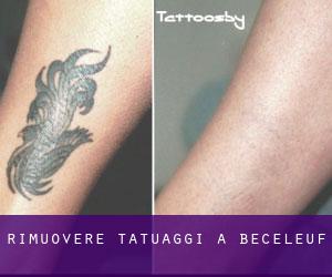 Rimuovere Tatuaggi a Béceleuf
