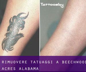 Rimuovere Tatuaggi a Beechwood Acres (Alabama)