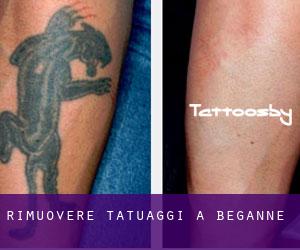 Rimuovere Tatuaggi a Béganne