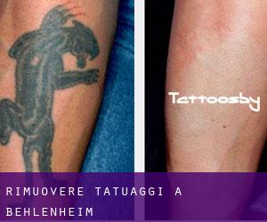 Rimuovere Tatuaggi a Behlenheim