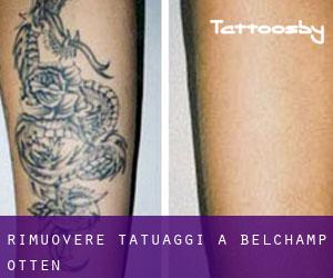Rimuovere Tatuaggi a Belchamp Otten