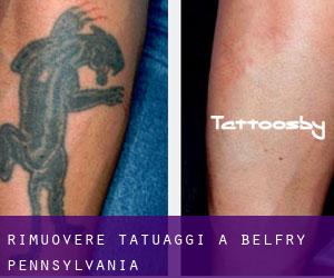 Rimuovere Tatuaggi a Belfry (Pennsylvania)