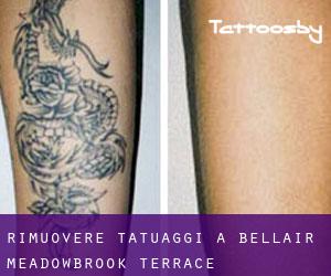 Rimuovere Tatuaggi a Bellair-Meadowbrook Terrace