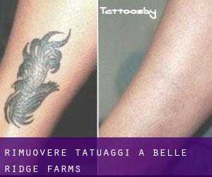 Rimuovere Tatuaggi a Belle Ridge Farms