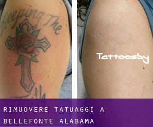 Rimuovere Tatuaggi a Bellefonte (Alabama)