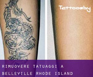 Rimuovere Tatuaggi a Belleville (Rhode Island)