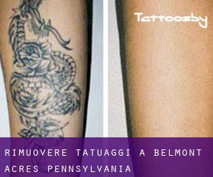 Rimuovere Tatuaggi a Belmont Acres (Pennsylvania)