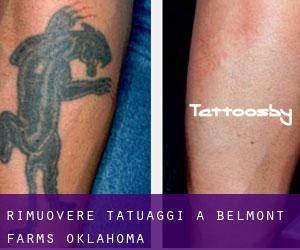 Rimuovere Tatuaggi a Belmont Farms (Oklahoma)