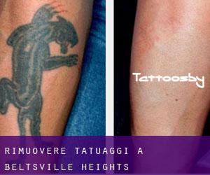 Rimuovere Tatuaggi a Beltsville Heights
