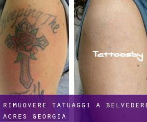 Rimuovere Tatuaggi a Belvedere Acres (Georgia)