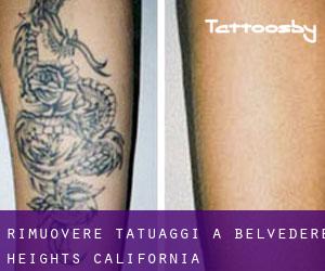 Rimuovere Tatuaggi a Belvedere Heights (California)
