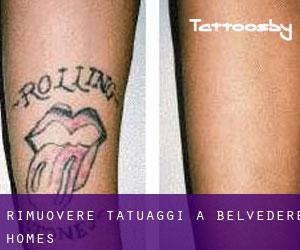 Rimuovere Tatuaggi a Belvedere Homes