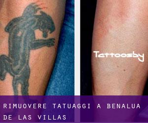 Rimuovere Tatuaggi a Benalúa de las Villas