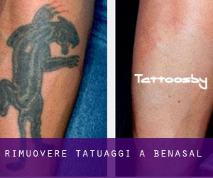 Rimuovere Tatuaggi a Benasal