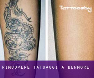 Rimuovere Tatuaggi a Benmore