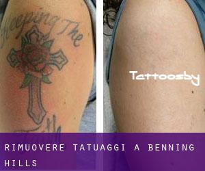 Rimuovere Tatuaggi a Benning Hills