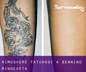 Rimuovere Tatuaggi a Benning (Minnesota)