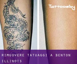 Rimuovere Tatuaggi a Benton (Illinois)
