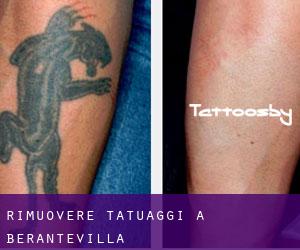 Rimuovere Tatuaggi a Berantevilla
