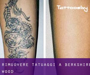 Rimuovere Tatuaggi a Berkshire Wood