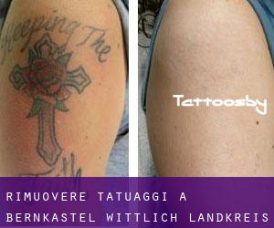 Rimuovere Tatuaggi a Bernkastel-Wittlich Landkreis