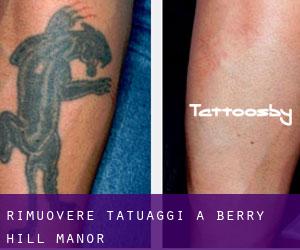 Rimuovere Tatuaggi a Berry Hill Manor
