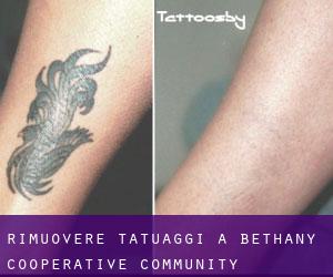 Rimuovere Tatuaggi a Bethany Cooperative Community