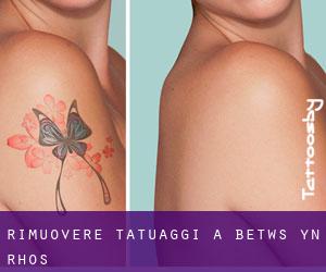 Rimuovere Tatuaggi a Betws-yn-Rhôs