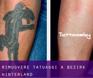 Rimuovere Tatuaggi a Bezirk Hinterland