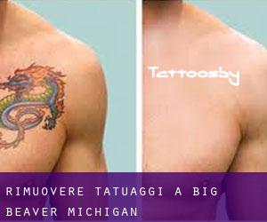 Rimuovere Tatuaggi a Big Beaver (Michigan)