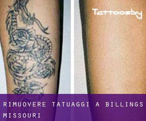 Rimuovere Tatuaggi a Billings (Missouri)