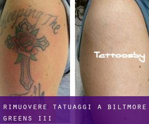 Rimuovere Tatuaggi a Biltmore Greens III
