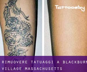 Rimuovere Tatuaggi a Blackburn Village (Massachusetts)