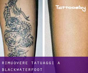 Rimuovere Tatuaggi a Blackwaterfoot