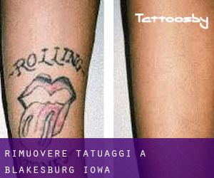 Rimuovere Tatuaggi a Blakesburg (Iowa)