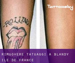 Rimuovere Tatuaggi a Blandy (Île-de-France)