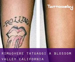 Rimuovere Tatuaggi a Blossom Valley (California)