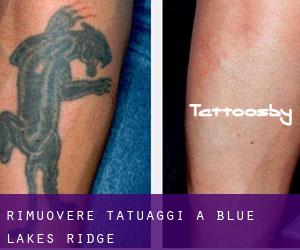 Rimuovere Tatuaggi a Blue Lakes Ridge