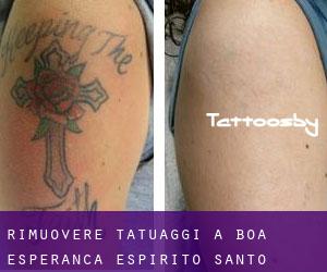 Rimuovere Tatuaggi a Boa Esperança (Espírito Santo)