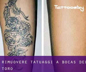 Rimuovere Tatuaggi a Bocas del Toro