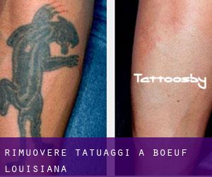 Rimuovere Tatuaggi a Boeuf (Louisiana)