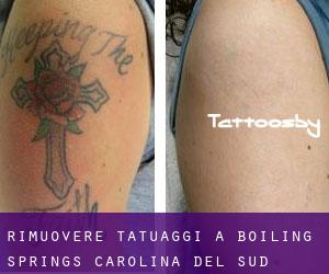 Rimuovere Tatuaggi a Boiling Springs (Carolina del Sud)